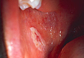 Oral candidiasis (thrush) in an infant's mouth
