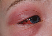 Young boy with inflamed eye due to cellulitis