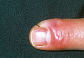 Cellulitis infection on a finger