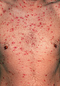Chickenpox blisters on chest