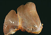 Polycystic liver disease