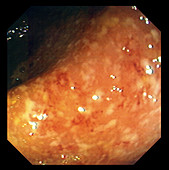 Ulcerative colitis