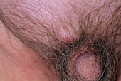 Sebaceous cyst and inguinal hernia