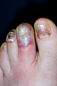 Cellulitis of the toes