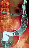 Inflamed colon and rectum,X-ray