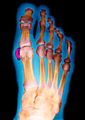 Calcified toe bone,X-ray