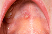Chicken pox lesion in mouth