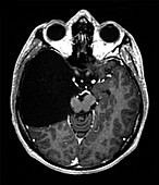 Arachnoid cyst,MRI scan