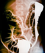 Crohn's disease,X-ray