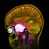 Arachnoid cyst,MRI scan