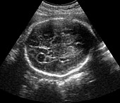 Choroid plexus cyst,ultrasound scan