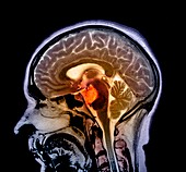 Brain cyst,MRI scan