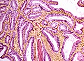 Inflamed gall bladder,light micrograph