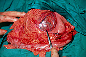 Surgery to remove cancer of outer wall of stomach