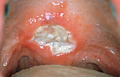 Rhabdomyosarcoma mouth cancer