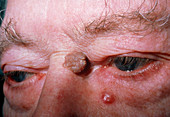 Basal cell carcinoma & seborrhoeic wart