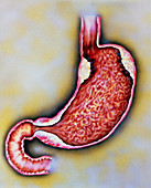 Artwork of different cancer locations in stomach