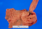 Specimen of stomach tissue diseased with carcinoma