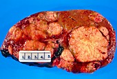 Liver affected by metastatic carcinoma