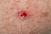 Basal cell carcinoma on skin on the back