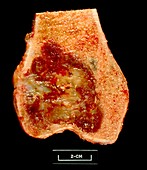 Gross specimen of femur with giant cell tumour