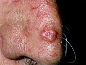 Basal cell carcinoma on nose of elderly man