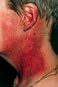 Neck with parotid cancer,red from radiotherapy