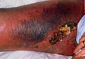 Ulcer on the leg of a woman with a groin lymphoma