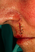 Sutured cut after excision of basal cell carcinoma