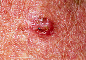 Basal cell carcinoma on a 78 year old man's skin