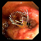 Colon cancer stent
