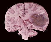 Brain tumour