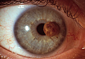 Eye cancer