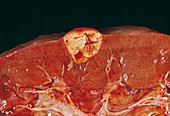 Secondary kidney cancer