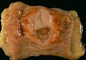 Secondary intestinal cancer