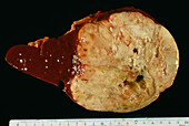 Spleen cancer,gross specimen