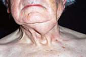 Neck tumour