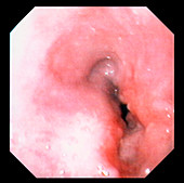 Oesophagus cancer