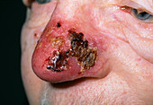 Skin cancer after treatment