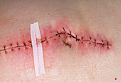 Infected post-operative wound