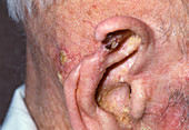 Ear after cancer treatment