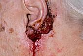 Skin cancer on the ear