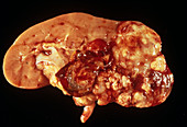 Kidney cancer