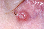 Basal cell carcinoma skin cancer