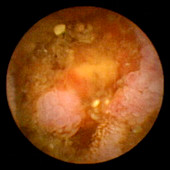 Secondary bowel cancer,pill camera view