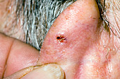 Basal cell carcinoma