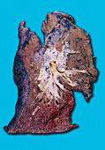 Squamous cell carcinoma lung cancer