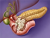 Pancreatic cancer,artwork