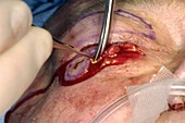 Skin cancer surgery