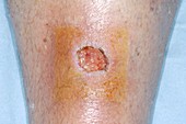 Failed skin graft for skin cancer
